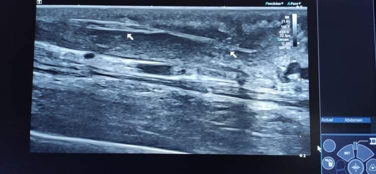 Échographie épillet